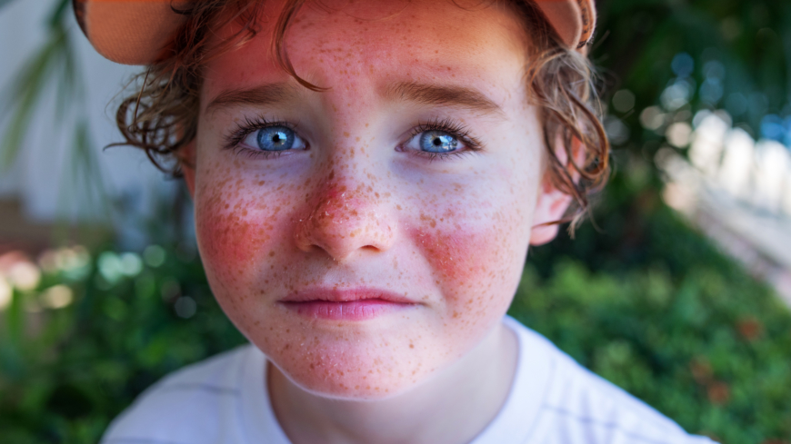 Många föräldrar skyddar sina telningar från solen bättre än förr men är inte lika duktiga på att skydda sig själva.  Foto: Shutterstock